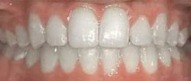 Image of Teeth After Cosmetic Dentistry | Cosmetic, Restorative and Implant Dentist in El Segundo and Carson California