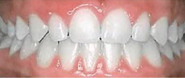 Image of Teeth After Cosmetic Dentistry | Cosmetic, Restorative and Implant Dentist in El Segundo and Carson California