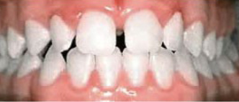 Image of Teeth Before Cosmetic Dentistry | Cosmetic, Restorative and Implant Dentist in El Segundo and Carson California