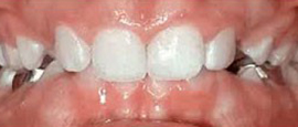 Image of Teeth Before Cosmetic Dentistry | Cosmetic, Restorative and Implant Dentist in El Segundo and Carson California