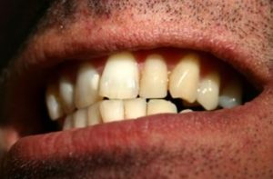 Crooked Teeth | Avalon Dental, your Carson and El Segundo Dentist