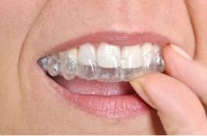 Lady putting Invisalign Clear Aligner Braces in | Avalon Dental, your Carson and El Segundo Dentist