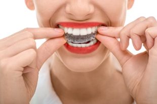 Lady taking Invisalign Clear Aligner Braces out | Avalon Dental, your Carson and El Segundo Dentist