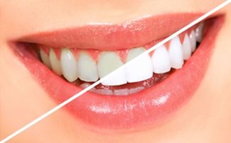 Image of a smile mouth. Half is dull and and the other half is white | Avalon Dental, your Carson and El Segundo Dentist