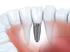 Image of a dental implant in the gums | Avalon Dental, your Carson and El Segundo Dentist