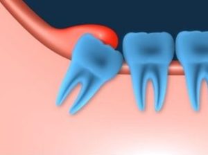 Image of a wisdom tooth rooted sideways in the gum | Avalon Dental, your Carson and El Segundo Dentist