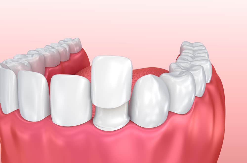 Image of a Composite Bonding on a tooth | Avalon Dental, your Carson and El Segundo Dentist