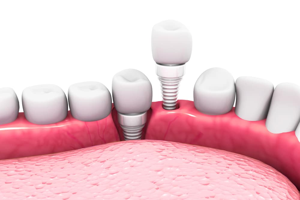 Image of a Dental Implant in a gum | Avalon Dental, your Carson and El Segundo Dentist