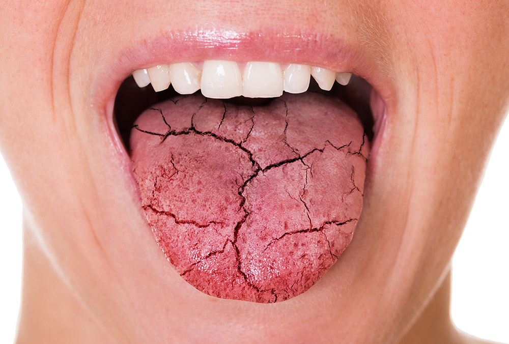 Dry Mouth and How to Treat It