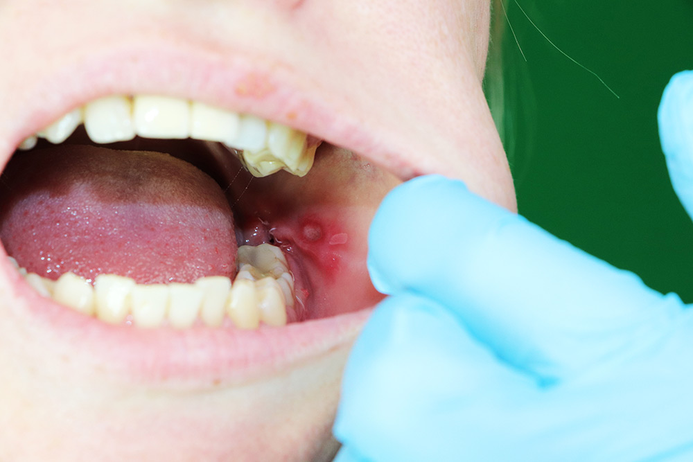 What Causes Mouth Sores and Infections?