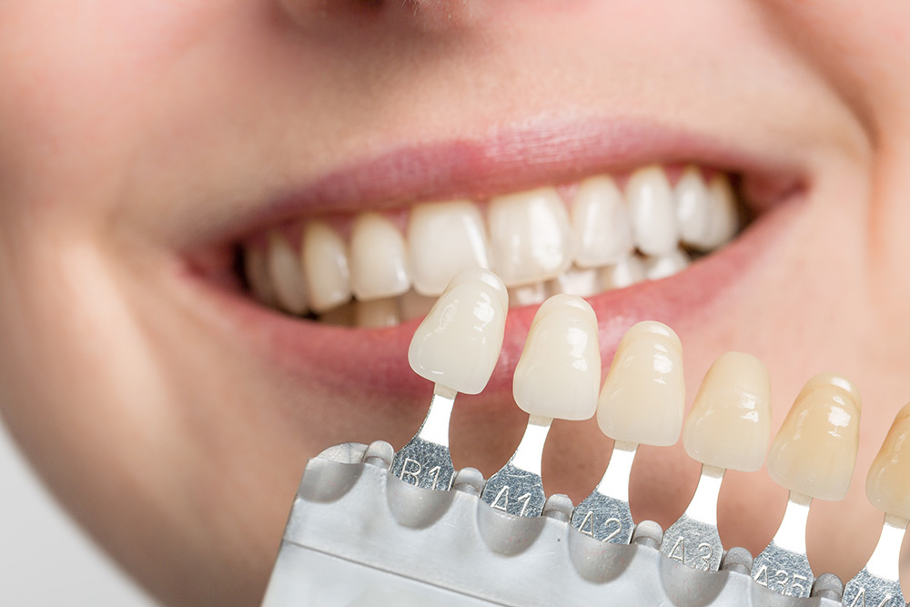 How Can Dental Veneers Transform My Smile?