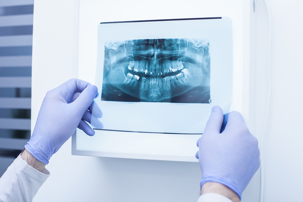 How Often Do I Need Dental X-Rays?