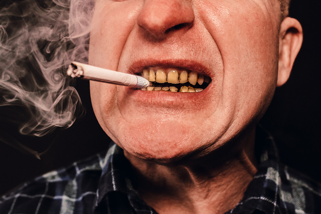 Man with yellow-stained teeth holding a cigarette, demonstrating the effects of smoking on oral health.