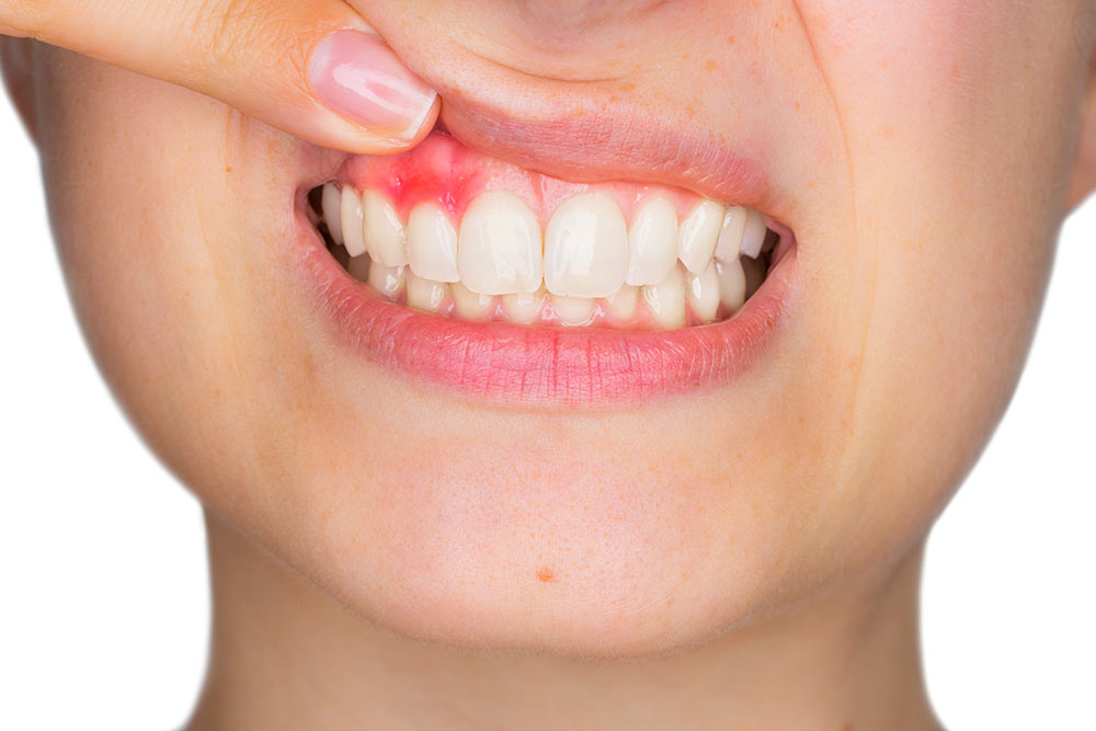 What Is Gingivitis and How Is It Treated?