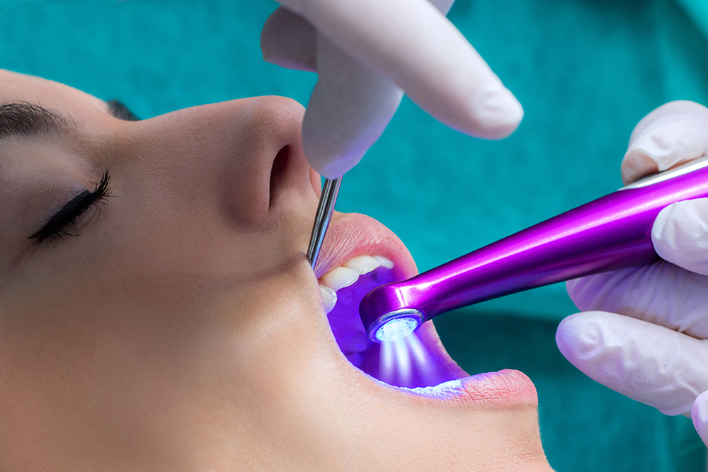 A close-up of a dental sealant application on an adult patient, featuring a dentist using a purple curing light on the patient's teeth, for the article 'Are Sealants Only for Children?