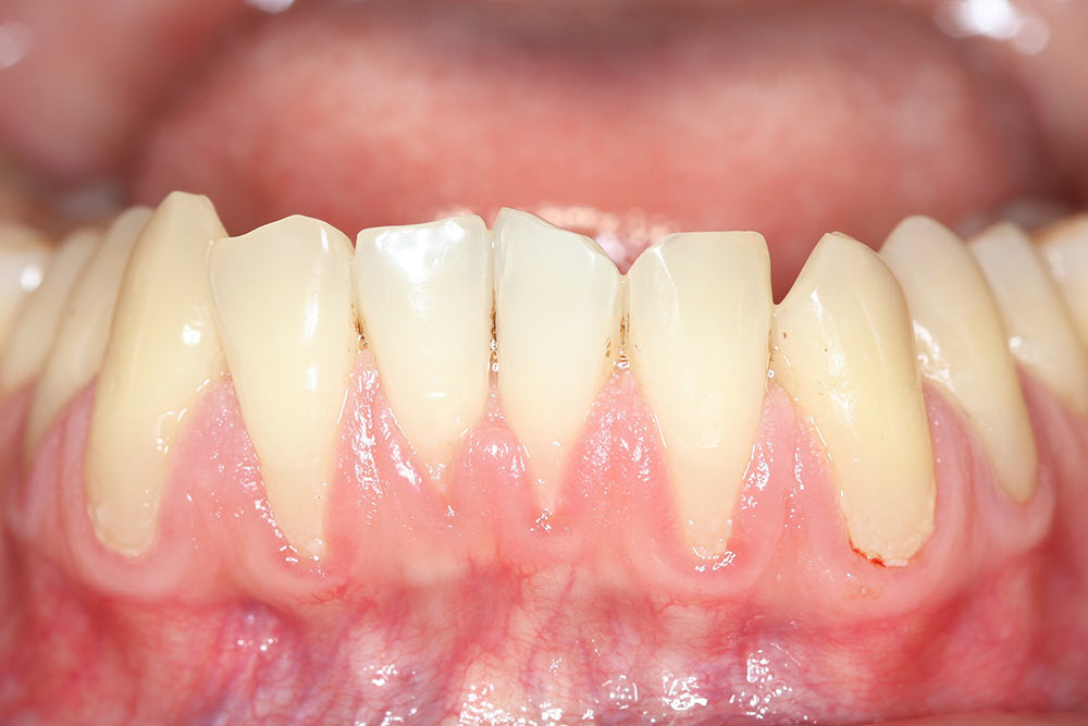 Close-up of a young woman's smile showing red, inflamed gums indicative of gingivitis, demonstrating what gingivitis looks like and its symptoms.