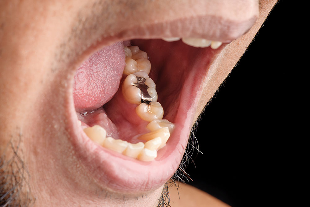 Close-up of a person's teeth with silver fillings for the article 'Should I Have My Silver Fillings Replaced?