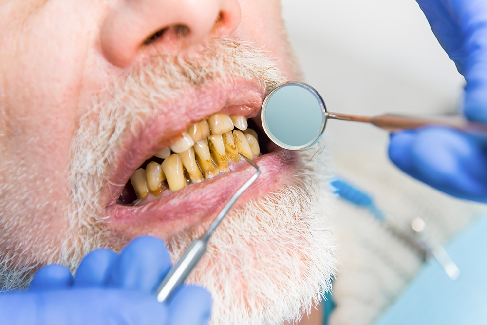 Dentist examining an older adult's stained teeth, highlighting increased susceptibility to tooth staining in older adults.