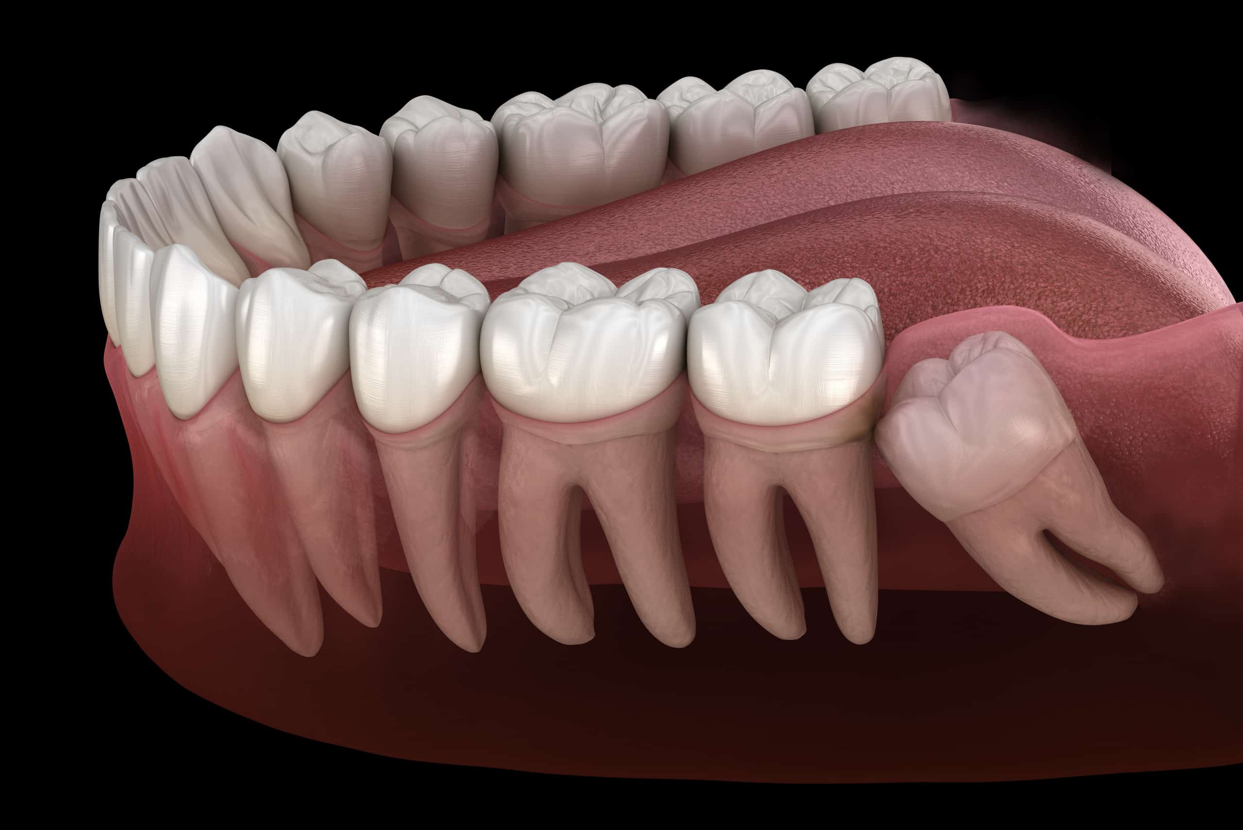 3D illustration of healthy teeth and a wisdom tooth with mesial impaction, highlighting the need for wisdom teeth removal