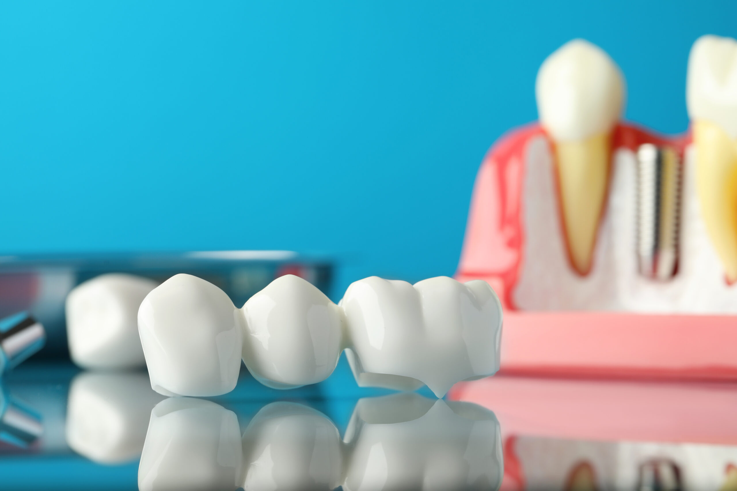 Revitalize Your Smile With a Dental Bridge